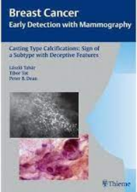 Casting Type Calcifications: Sign of a Subtype with Deceptive Features