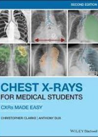 Chest X-Rays for Medical Students