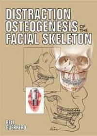 Distraction Osteogenesis of the Facial Skeleton